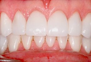 Before and After Dental Fillings in Bay Shore