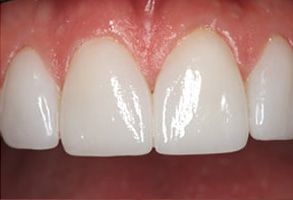 Before and After Dental Bleaching in Bay Shore