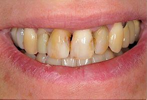 Before and After Dental Implants in Bay Shore