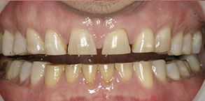 Bay Shore Before and After Dental Braces