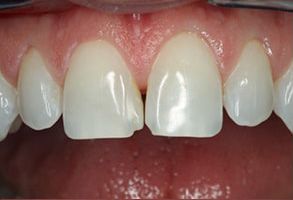 Bay Shore Before and After Dental Bleaching